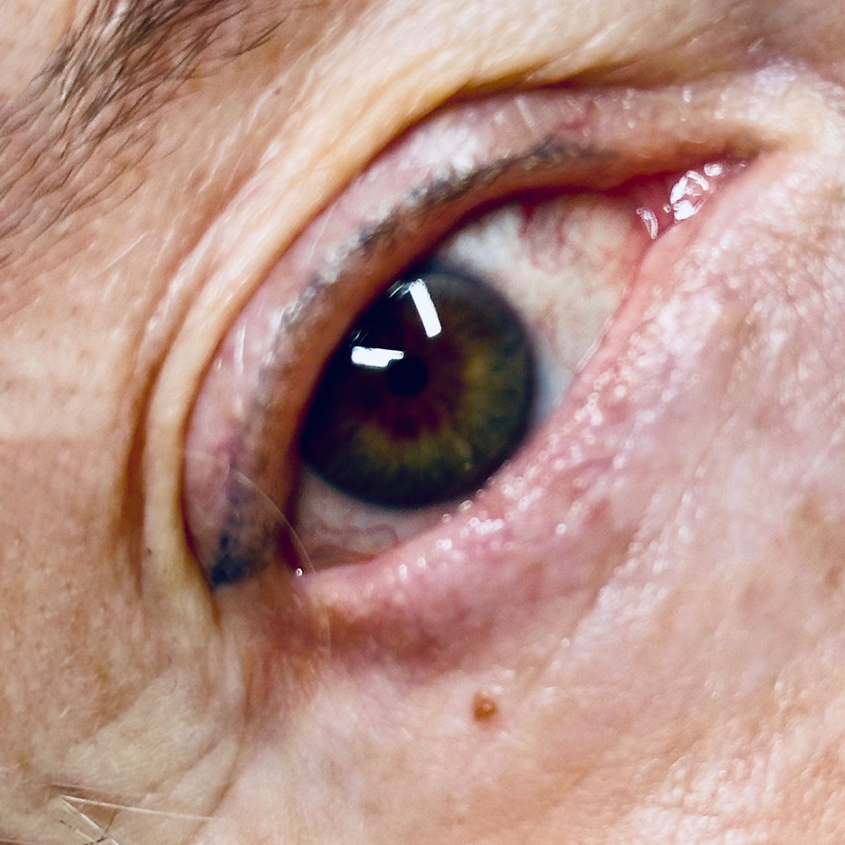 micropigmentacion oncologica antes